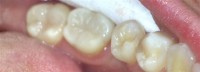 Bolesti zuba 3